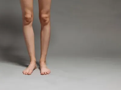 다리에 핏줄이 도드라진다면 — 하지정맥류일 때…